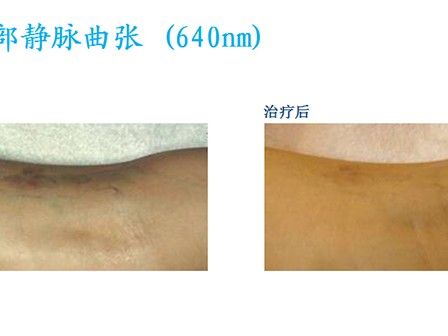 光子嫩肤技术培训：让你变美更专业的秘密法宝