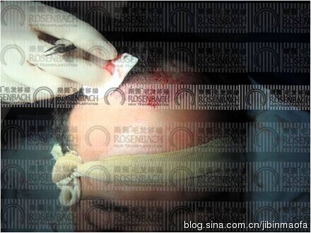 从“须少”到“美髯公”：揭秘当下最好的胡须移植技术如何重塑男人面子